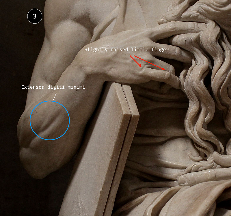 Muscle ripple at the root of the little finger and an elevated extensor digiti minimi